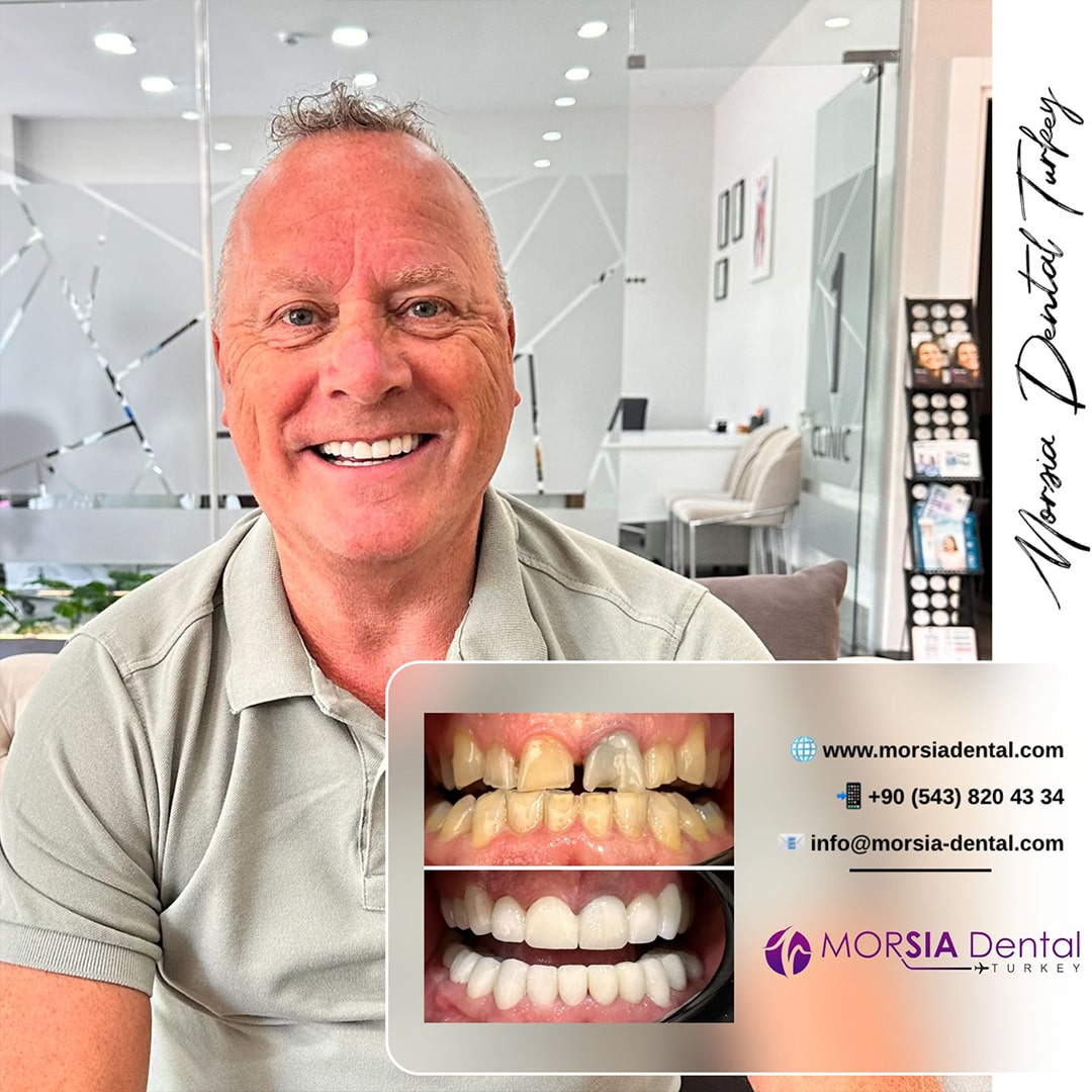 morsia-before-after-100-min