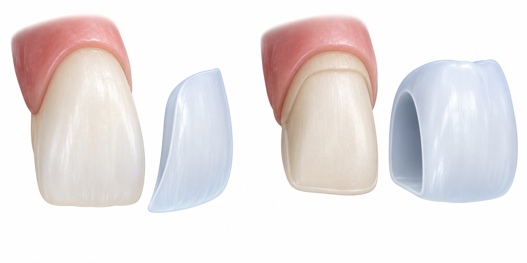 Educational models showing a thin front-surface veneer and a full-coverage crown